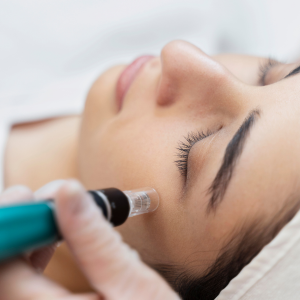 Exosomes Microneedling for Fine Lines and Wrinkles