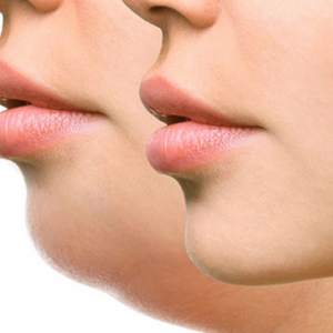 KYBELLA®