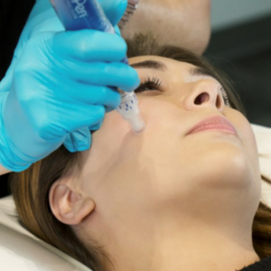 SkinPen Microneedling procedure at Trinity Med Spa.