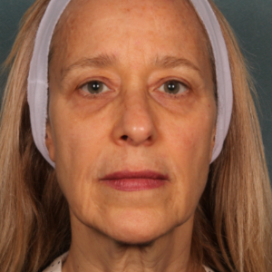 before inject pic. 7